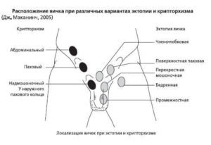 Крипторхизм, мошонка, яички, гормоны