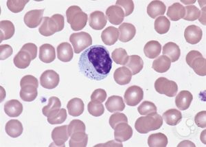 Атипичные лимфоциты и плазматические клетки