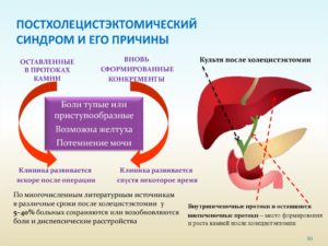 Постхолецистэктомический синдром