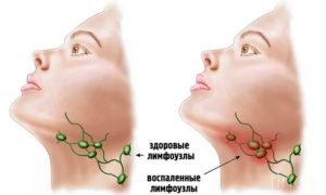 Увеличение лимфатических узлов по челюстью