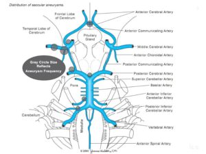 Аневризма основной артерии головного мозга