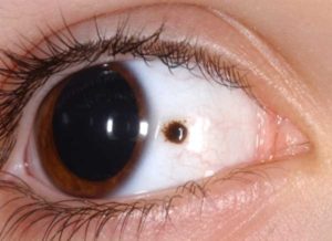 Черная точка на белке глаза
