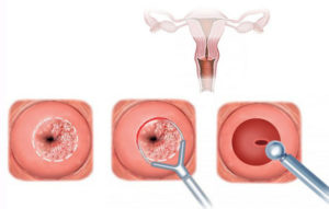 Менструация после биопсии