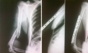 Неправильное сращение перелома в/3 плечевой кости