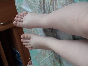 Беременность 35 недель отек ног