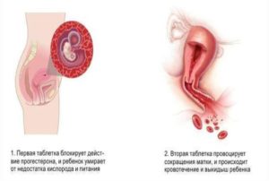 Секс после Медикаментозного аборта