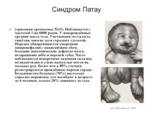 Трисомия 16 хромосомы при исследовании абортуса