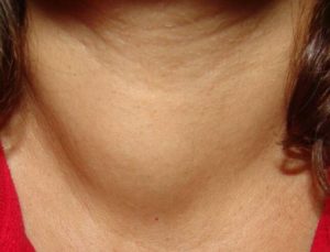 Рост узла щитовидной железы