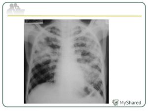 Скрытая пневмония или туберкулез