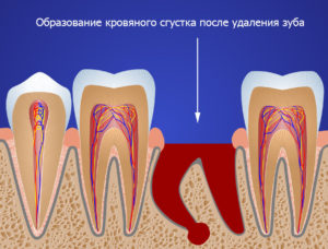 Дырка после удаления зуба