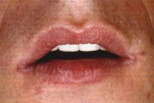 Жжение губ и кончика языка, трещины в уголках губ