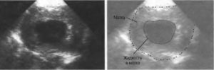 Свободная жидкость в позадиматочном пространстве при беременности