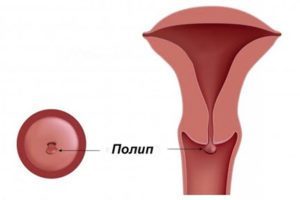 Полип цервикального канала повторно появится снова?