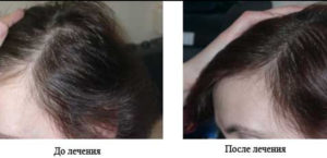Выпадение волос при низком ферритине