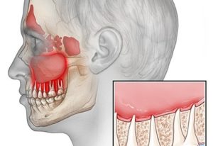 Боль под челюстью после удаления зубов