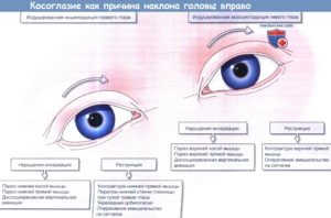 Парез прямых мышц глаза (левого) и ркт