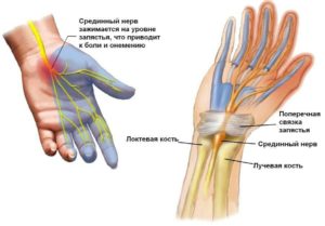 Болит локоть немеют пальцы