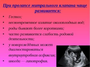 Пролапс митрального клапана и беременность
