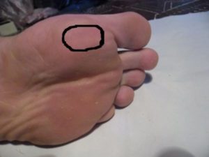 Боль подушечки большого пальца ноги