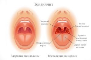 Тонзиллит, ком в горле