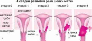 Рак шейки матки 1 А стадии