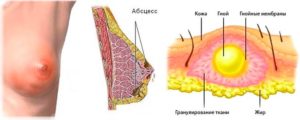 Не проходит прыщ на молочной железе