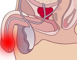 Что колят под яички при лечении простатита