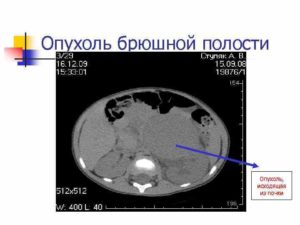 Объемное образование брюшной полости плода