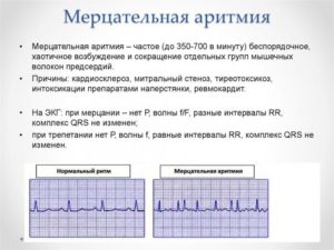 Мерцательная аритмия вагусного типа