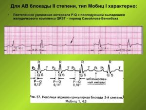 СССУ, БЛОКАДА самойлова венкебаха