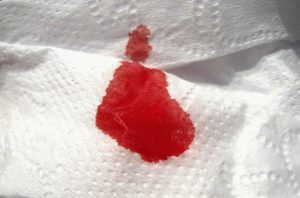 Кровь в кале после родов
