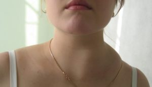 Липома в мягких тканях шеи, увеличенный лимфоузел