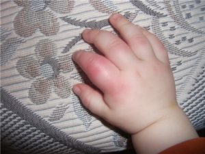 Опух пальчик у ребенка