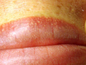 Покраснение половых губ