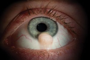 Желеобразное образование на белке глаза