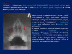 Инфильтративно-воспалительные изменения слизистой обеих верхнечелестной пазухи носа