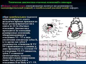 Изменения задне-боковой стенки миокарда неспецифического характера