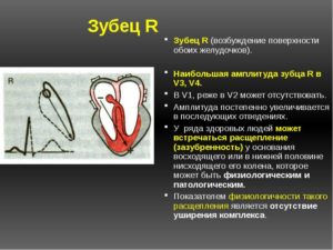 Отсутствие зубца R на V2