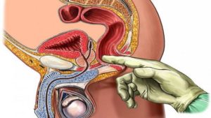 Боль после массажа простаты