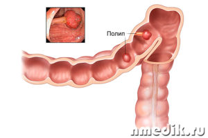 Полипы желудка