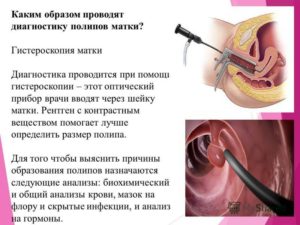 Результат ПГИ после удаления полипа ц. к