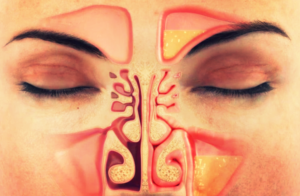Как избавиться от запаха из носа после лечения гайморита