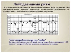 Расшифровка КТГ 8 баллов, много акцелираций и присутствуют децелерации