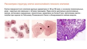 U - Эпителий плоский поверхностного слоя 10-15 в п/зр