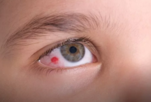 Красные капилляры в глазах у ребёнка 2,8 лет