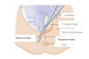 Кровит шов в промежности после родов