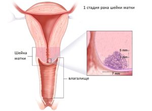 Рак шейки матки 1 А стадии
