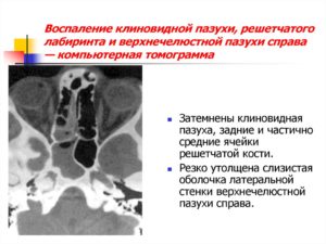 Инфильтративно-воспалительные изменения слизистой обеих верхнечелестной пазухи носа