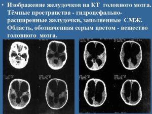 Дилатация боковых желудочков