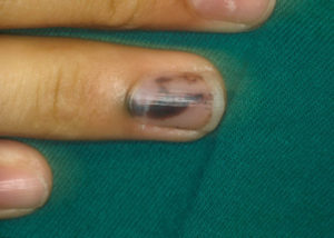 На ногте тёмное пятно появилось внезапно, без травм, что это?